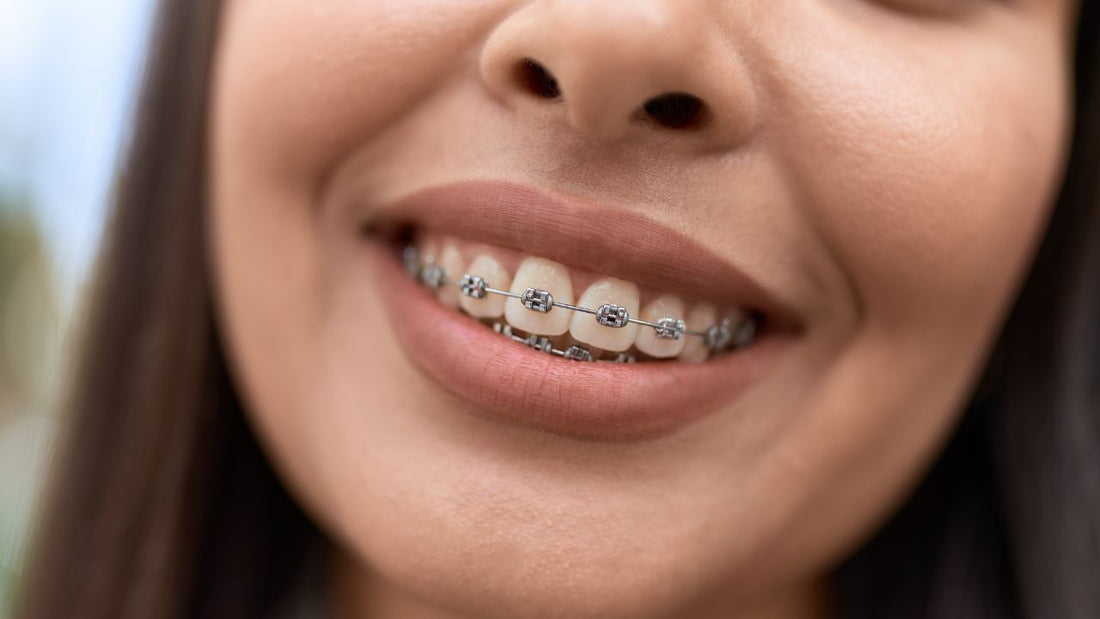 How to Get Rid of Brace Stains