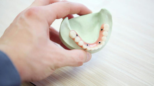 Bridges vs Implants: Which is the Best Tooth Replacement Option - Pros & Cons