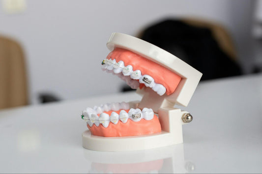 Composite Bonding: Composite veneers vs Edge Bonding