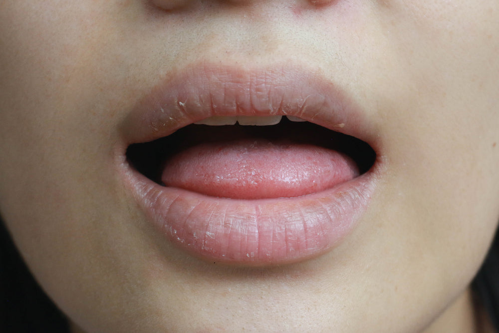 Dry Mouth - All the Symptoms, Causes & the Right Treatment