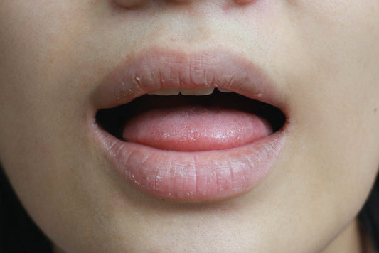 Dry Mouth - All the Symptoms, Causes & the Right Treatment