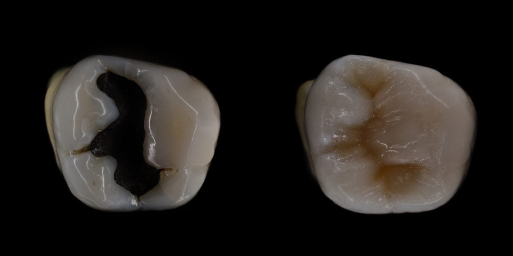 What’s the difference between amalgam and composite fillings?