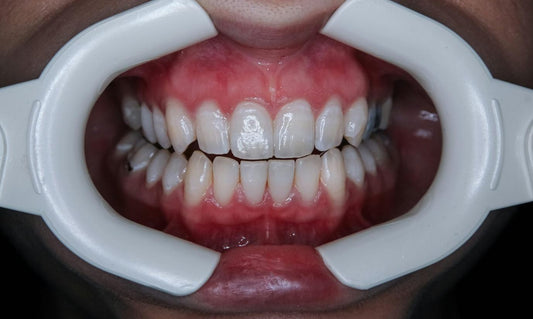 a person's mouth with teeth - Teeth Whitening Sensitivity: Causes, How to Avoid It & Tips