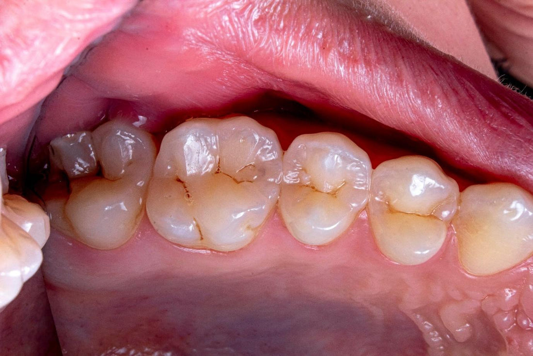 What is Tooth Erosion? Causes, Symptoms, Diagnosis & Treatment