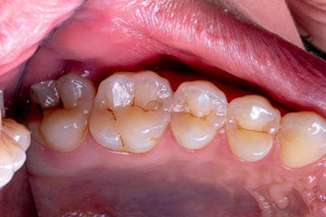 What is Tooth Erosion? Causes, Symptoms, Diagnosis & Treatment