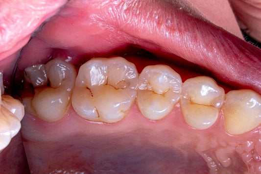 What is Tooth Erosion? Causes, Symptoms, Diagnosis & Treatment