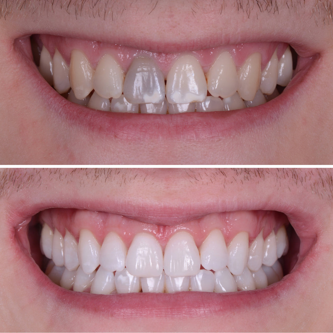 Why Choose Enlighten Whitening – Enlighten Smiles