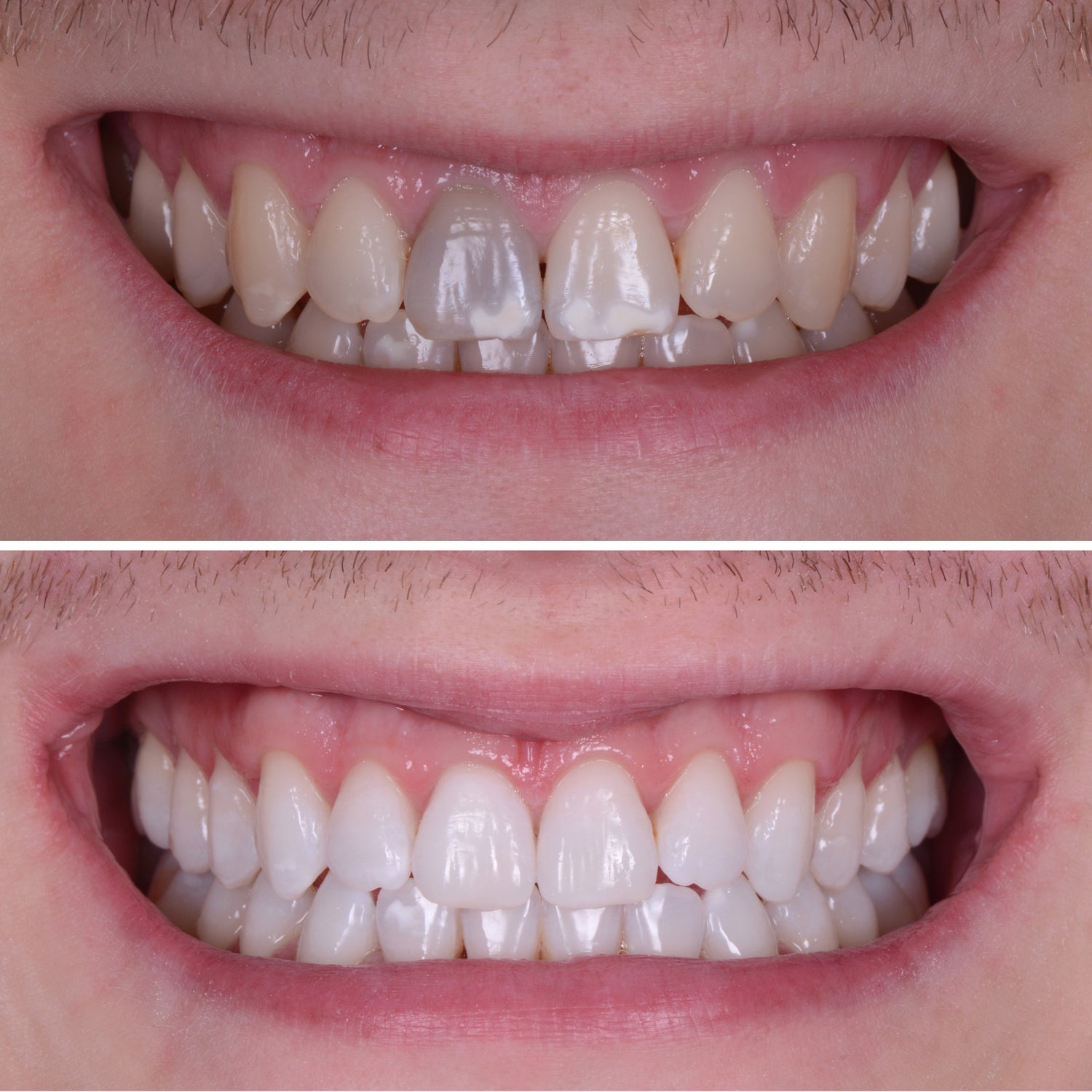Why Choose Enlighten Whitening – Enlighten Smiles
