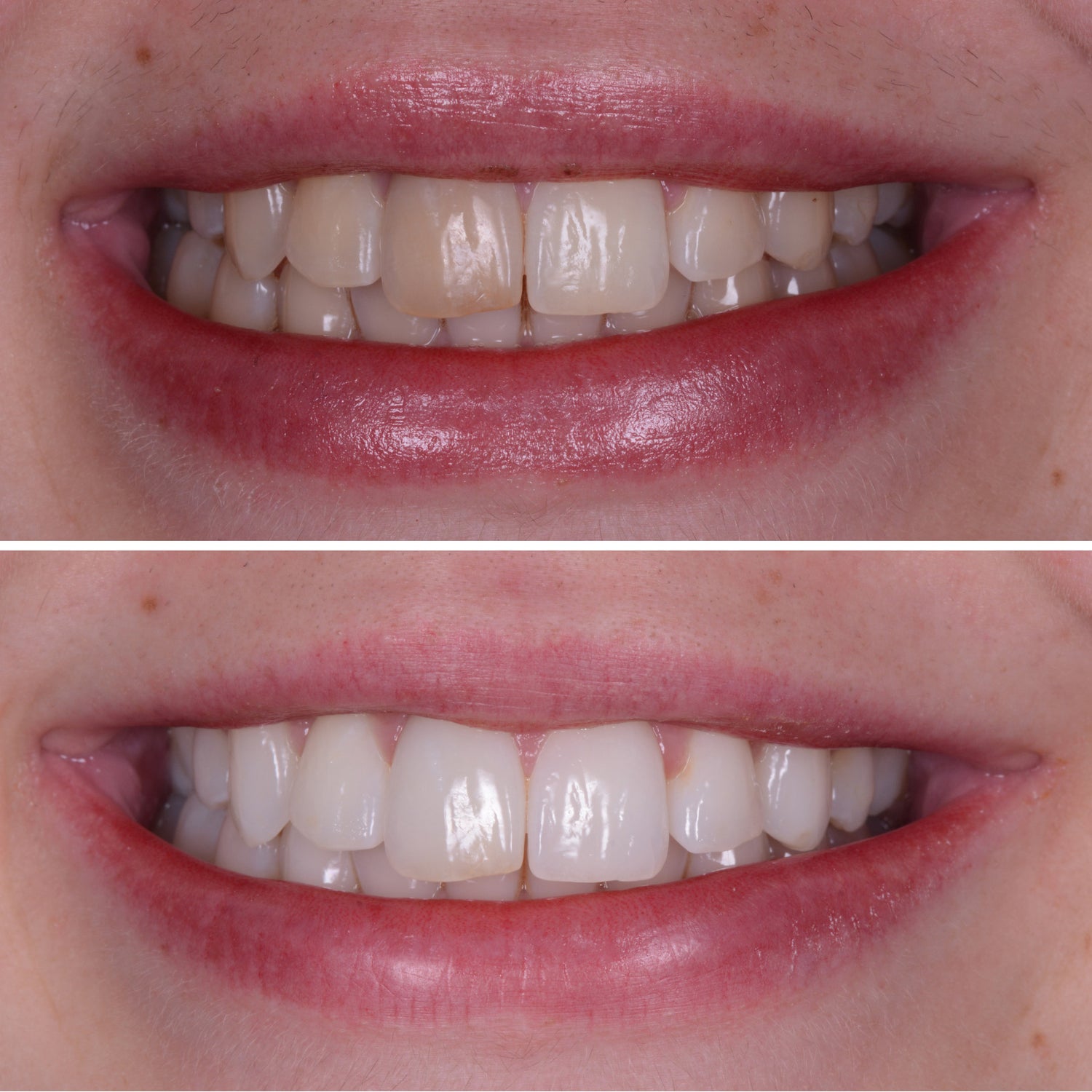 Why Choose Enlighten Whitening – Enlighten Smiles