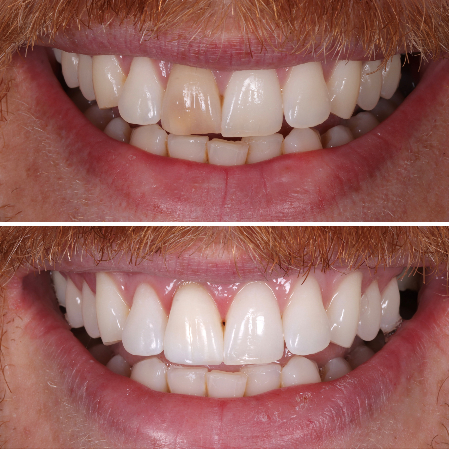 Enlighten Teeth Whitening Solutions - London - Enlighten Smiles